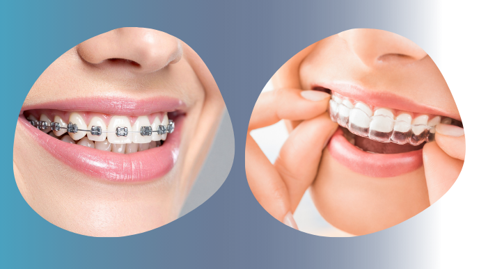 000833_ortodoncia-vs-brackets.png