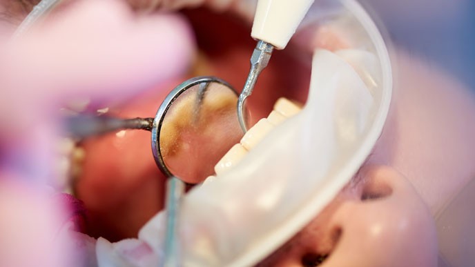 ¿Duele un curetaje dental? Qué esperar antes, durante y después