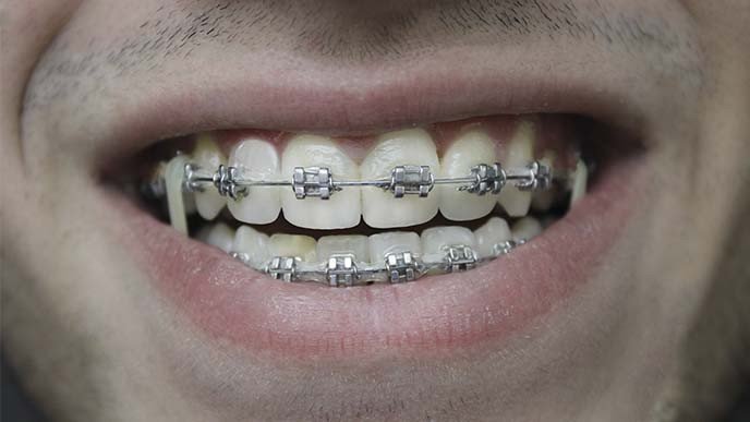 ¿Qué son los retenedores en ortodoncia?