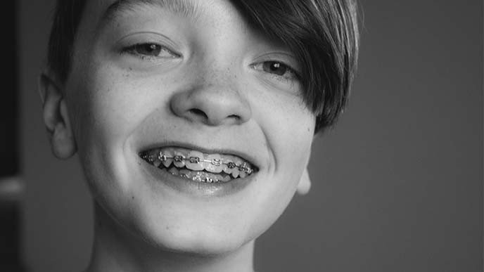 ¿Qué es una ortodoncia fija?
