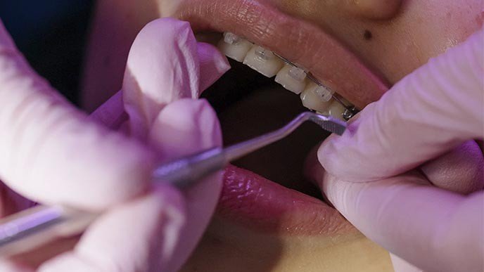 ¿Cómo es el tratamiento de ortodoncia?