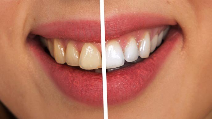 ¿Cuál es el mejor blanqueamiento dental según la OCU?