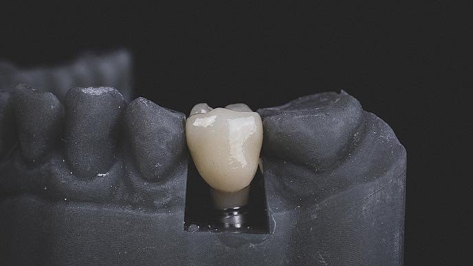 ¿Son los implantes osteointegrados para siempre?