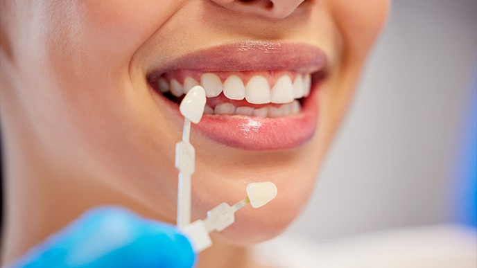 Blanqueamiento dental: ¿es seguro? Resultados y cuidados posteriores