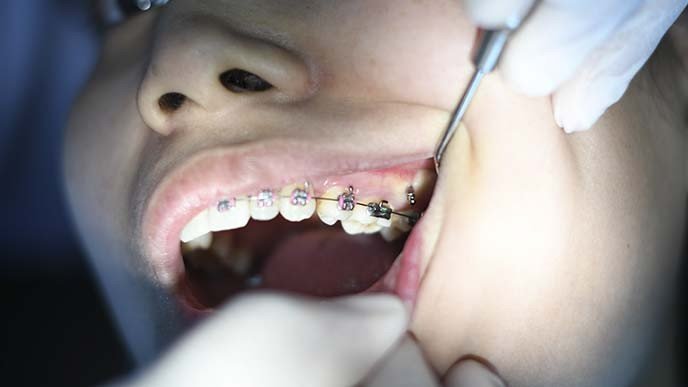 Diferencias entre ortodoncia invisible y Brackets