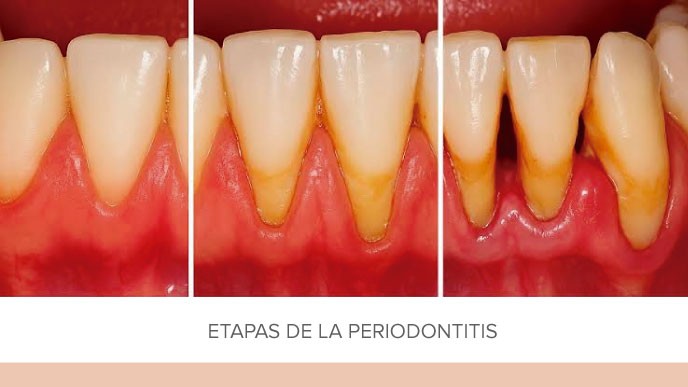 ¿Qué relación existe entre periodontitis y diabetes?