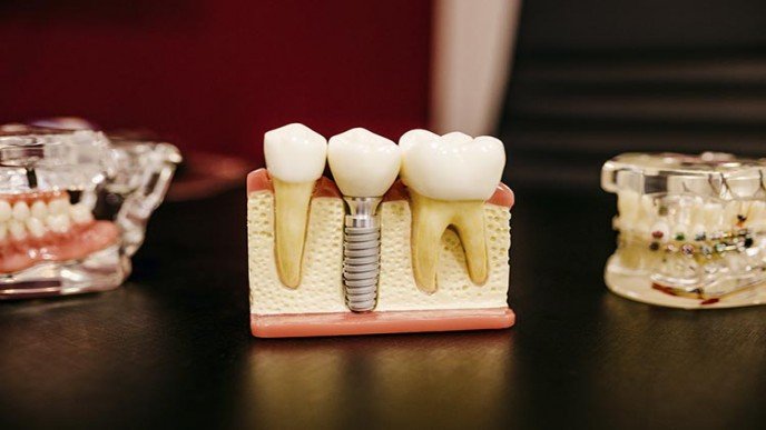 ¿Qué sucede si no ponemos un implante dental?