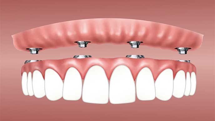 ¿Cuántos implantes dentales se pueden poner en una sesión?