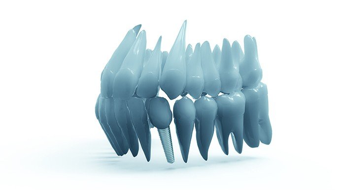 ¿Qué diferencias hay entre implantes de titanio y de zirconio?