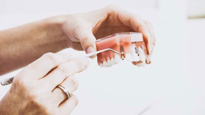 ¿Cuáles son las ventajas de las prótesis dentales fijas?